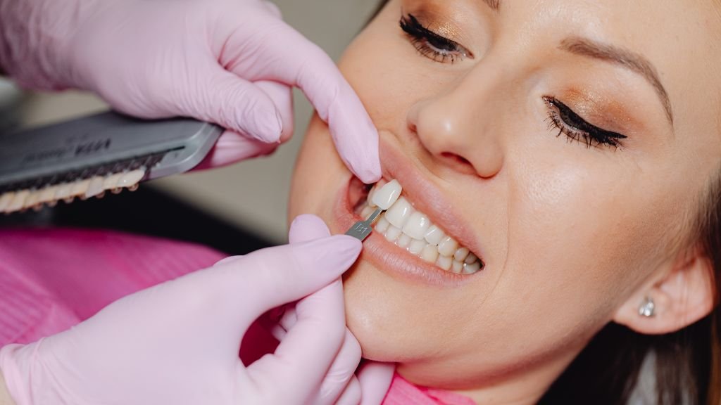 Veneers