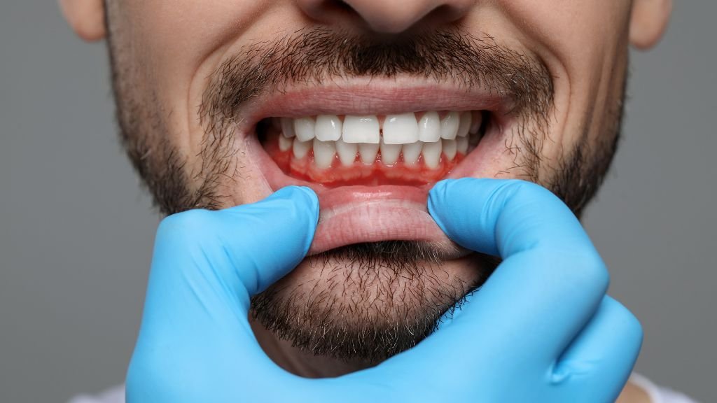 gum recession