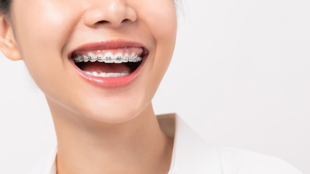 braces stains