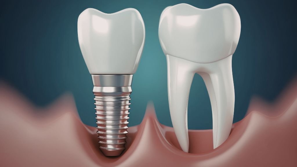 dental implants cost