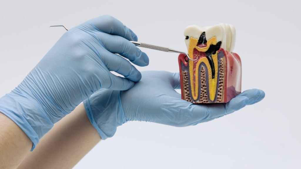 root canal treatment