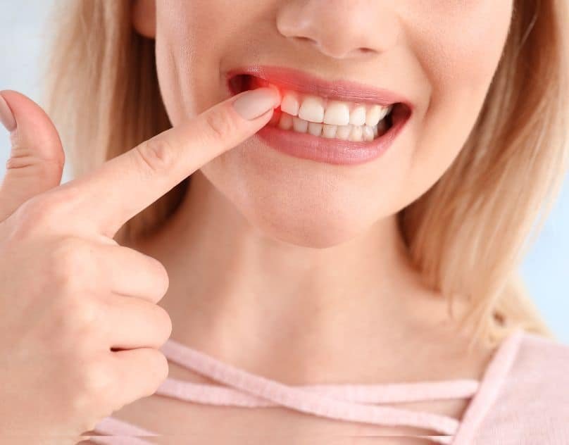 Receding gums