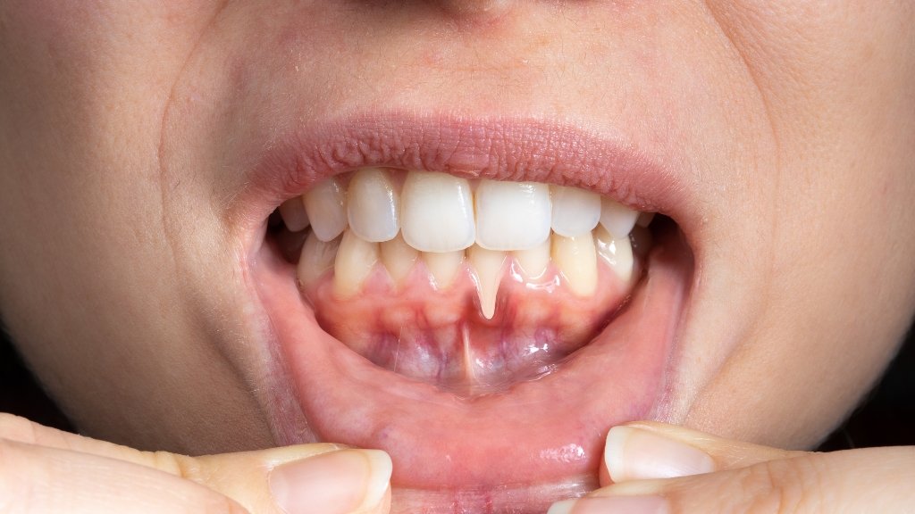 causes of black gums