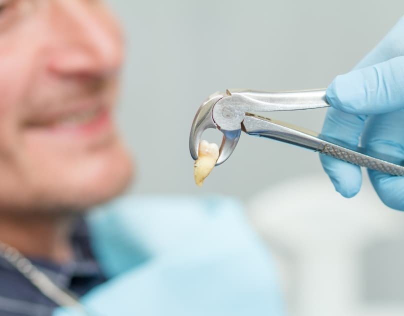 Dental Extraction