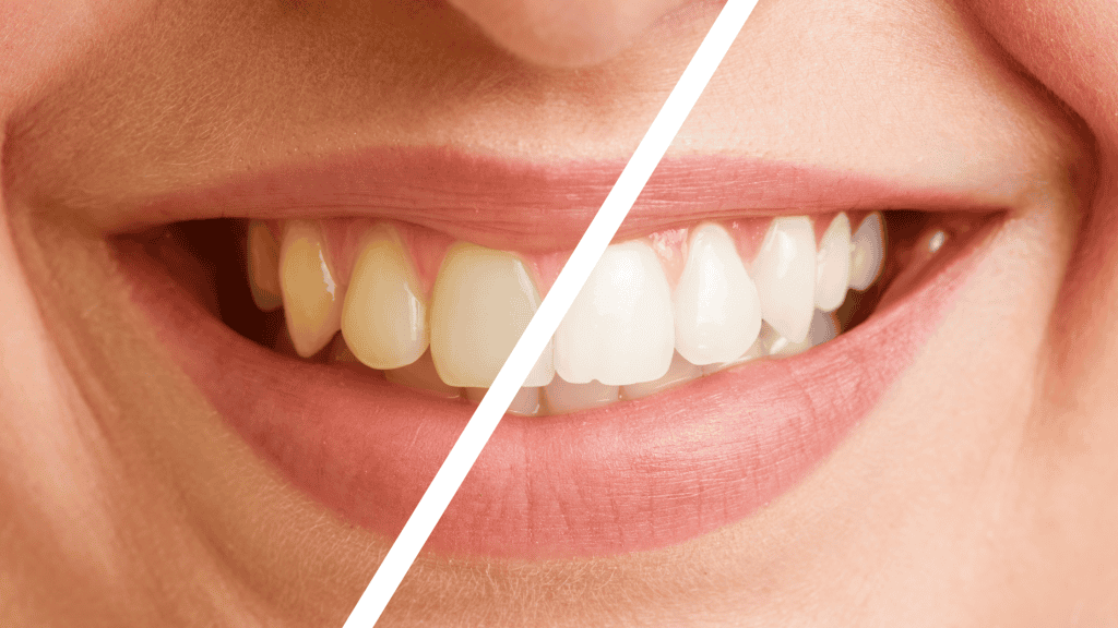 teeth whitening treatments