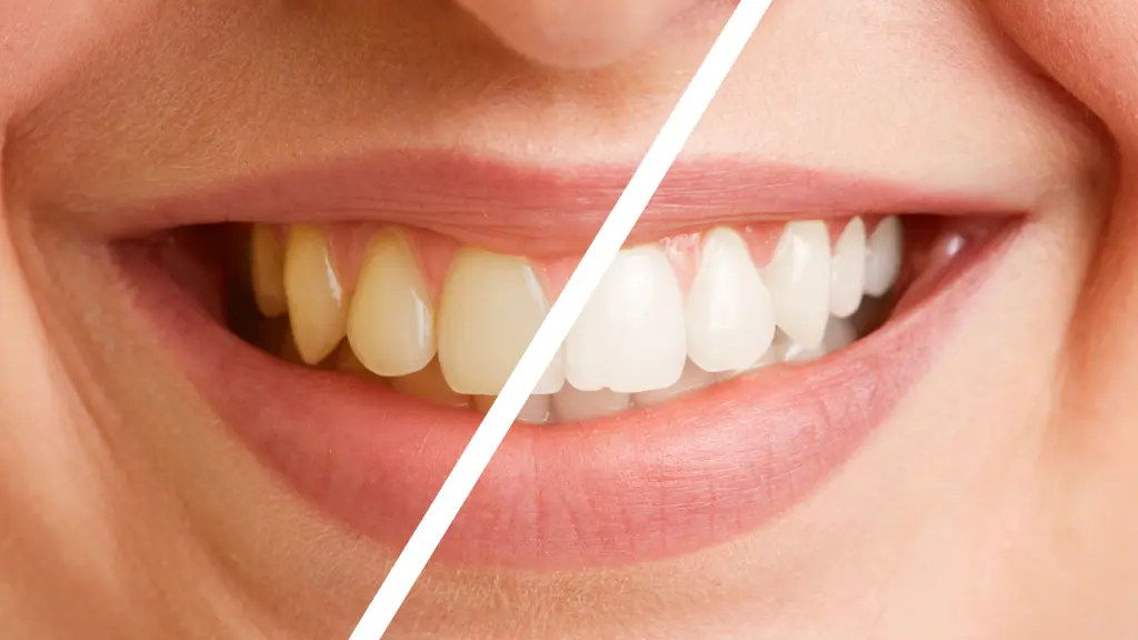 teeth whitening treatments
