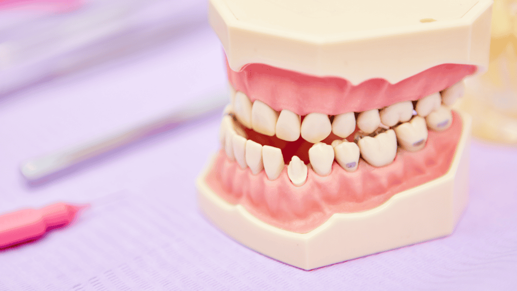malocclusion
