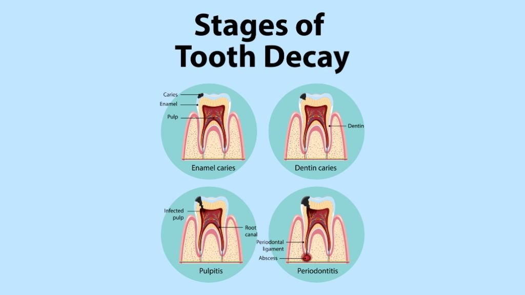 stages of tooth decay