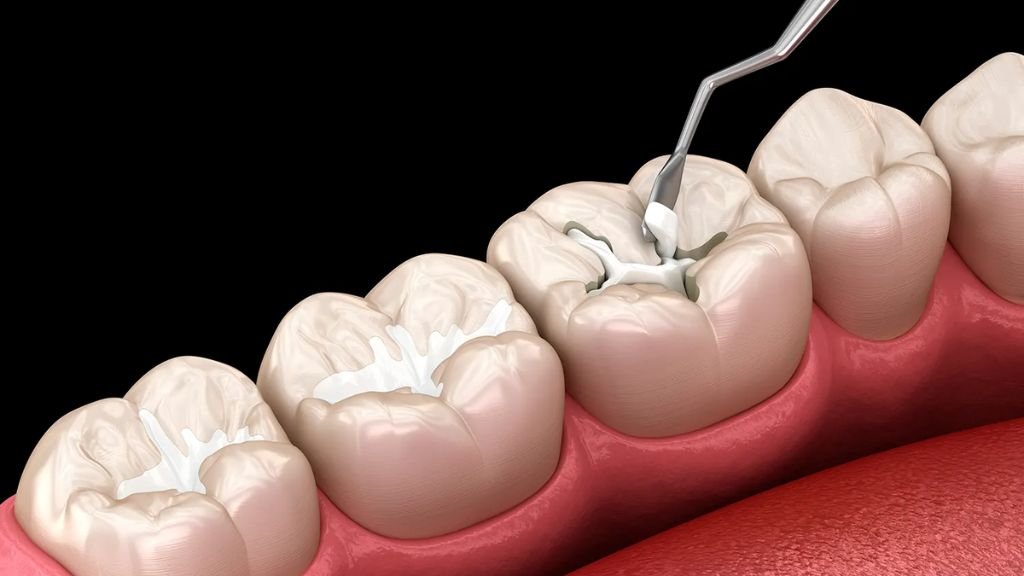 fissure sealants