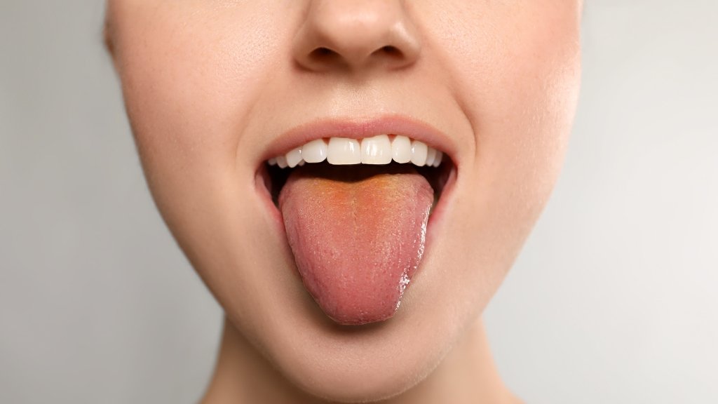 oral thrush
