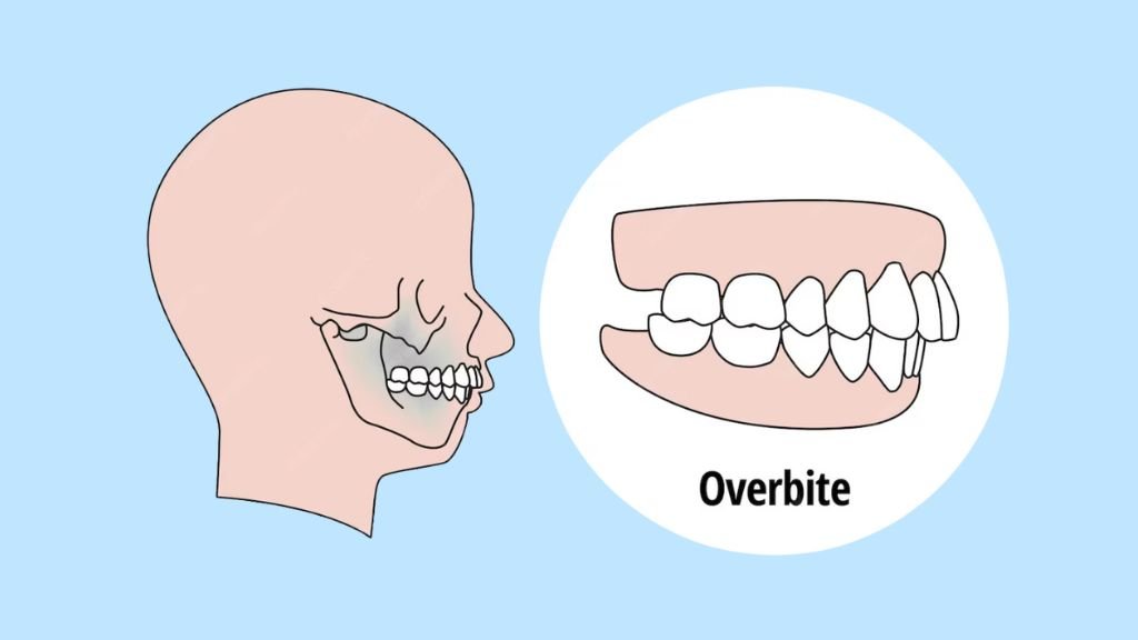 overbite correction
